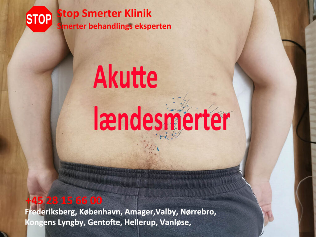 Akutte lændesmerter i Frederiksberg