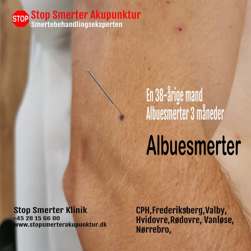 Albuesmerter